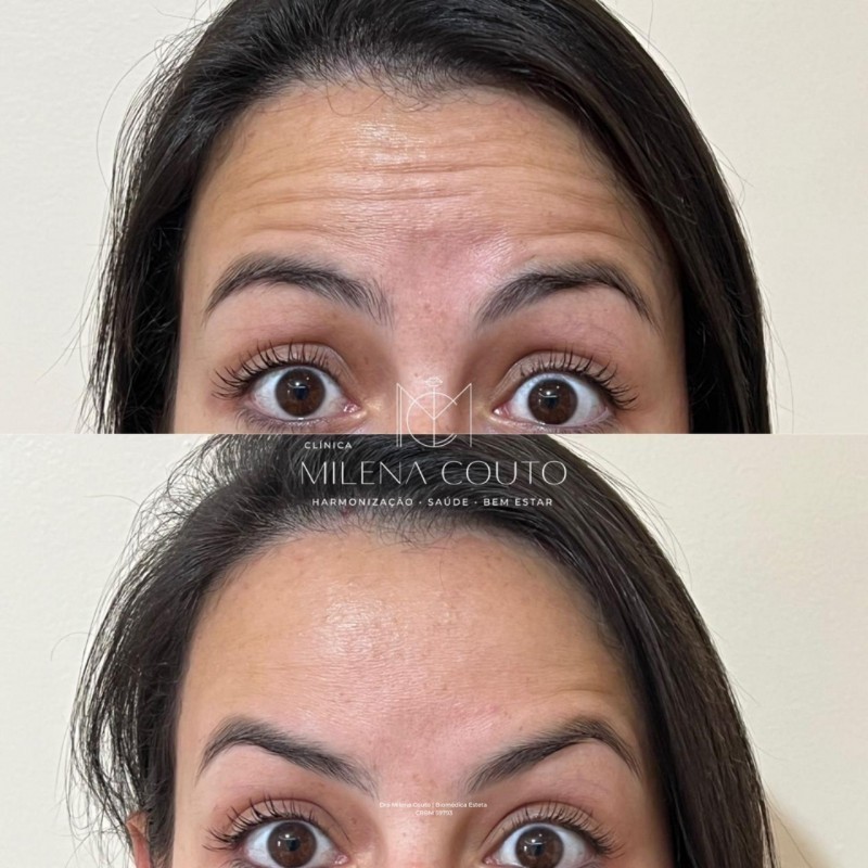 Toxina Botulínica (botox)