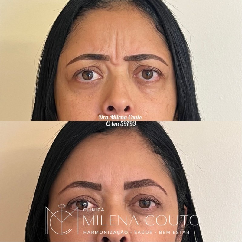 Toxina Botulínica (botox)