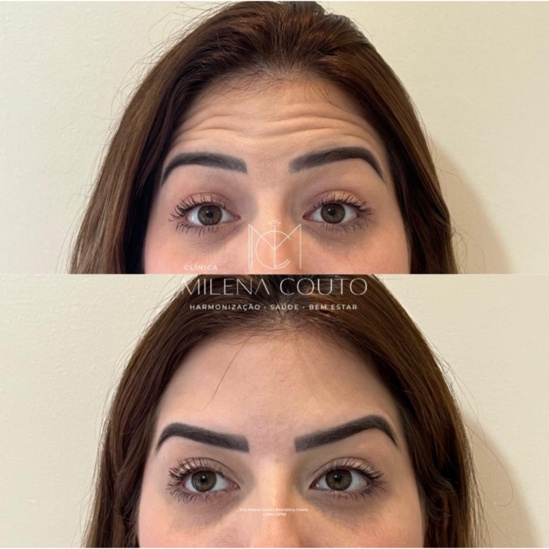Toxina Botulínica (botox)