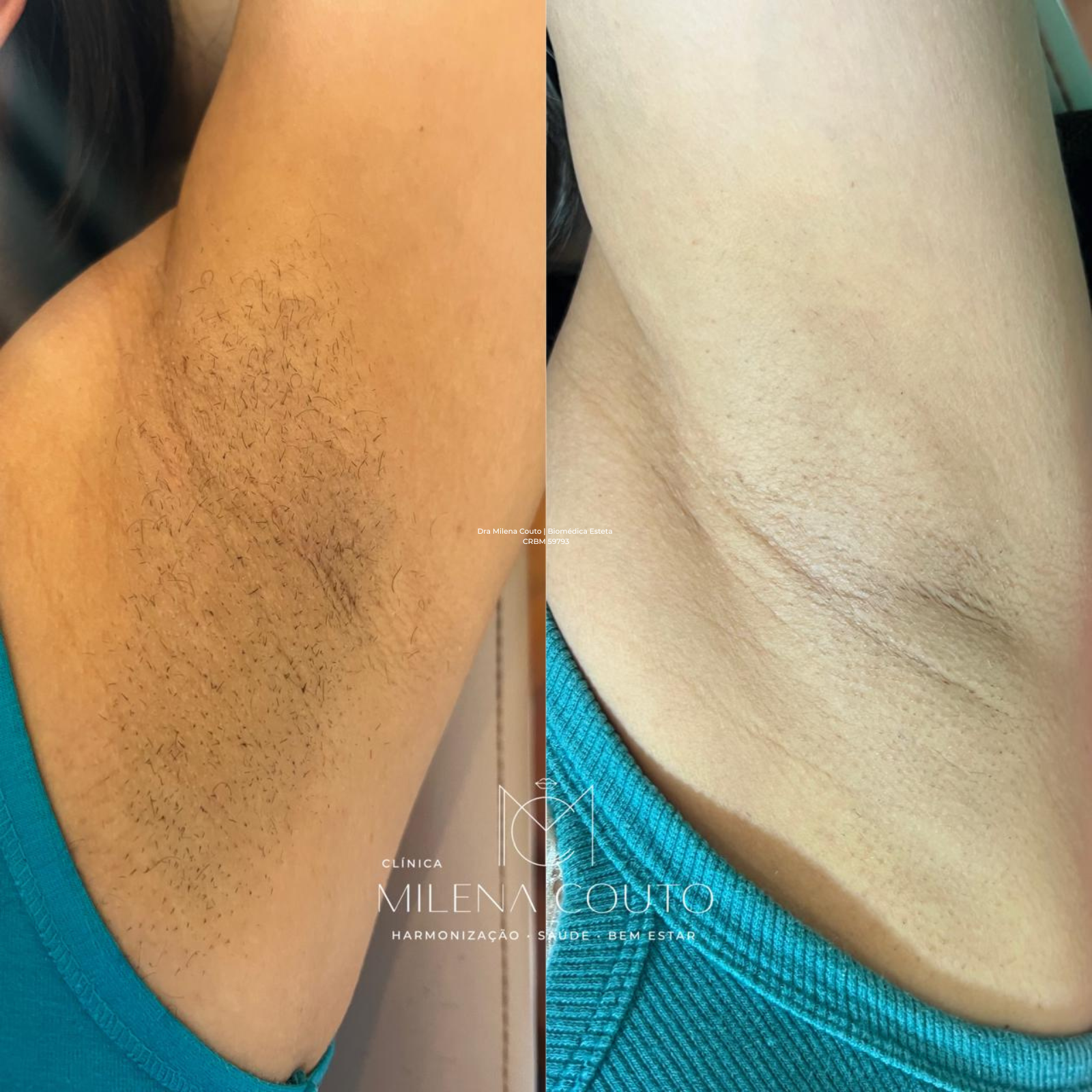 Depilação a laser nas axilas