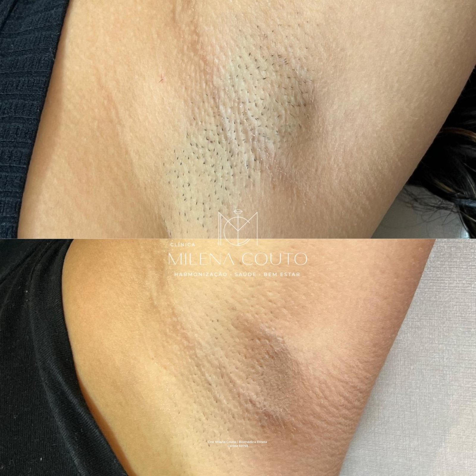 Depilação a laser nas axilas