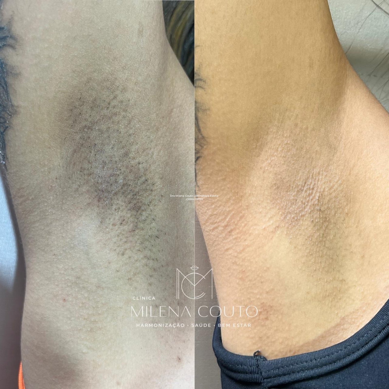 Depilação a laser nas axilas