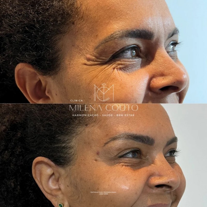 Toxina Botulínica (botox)