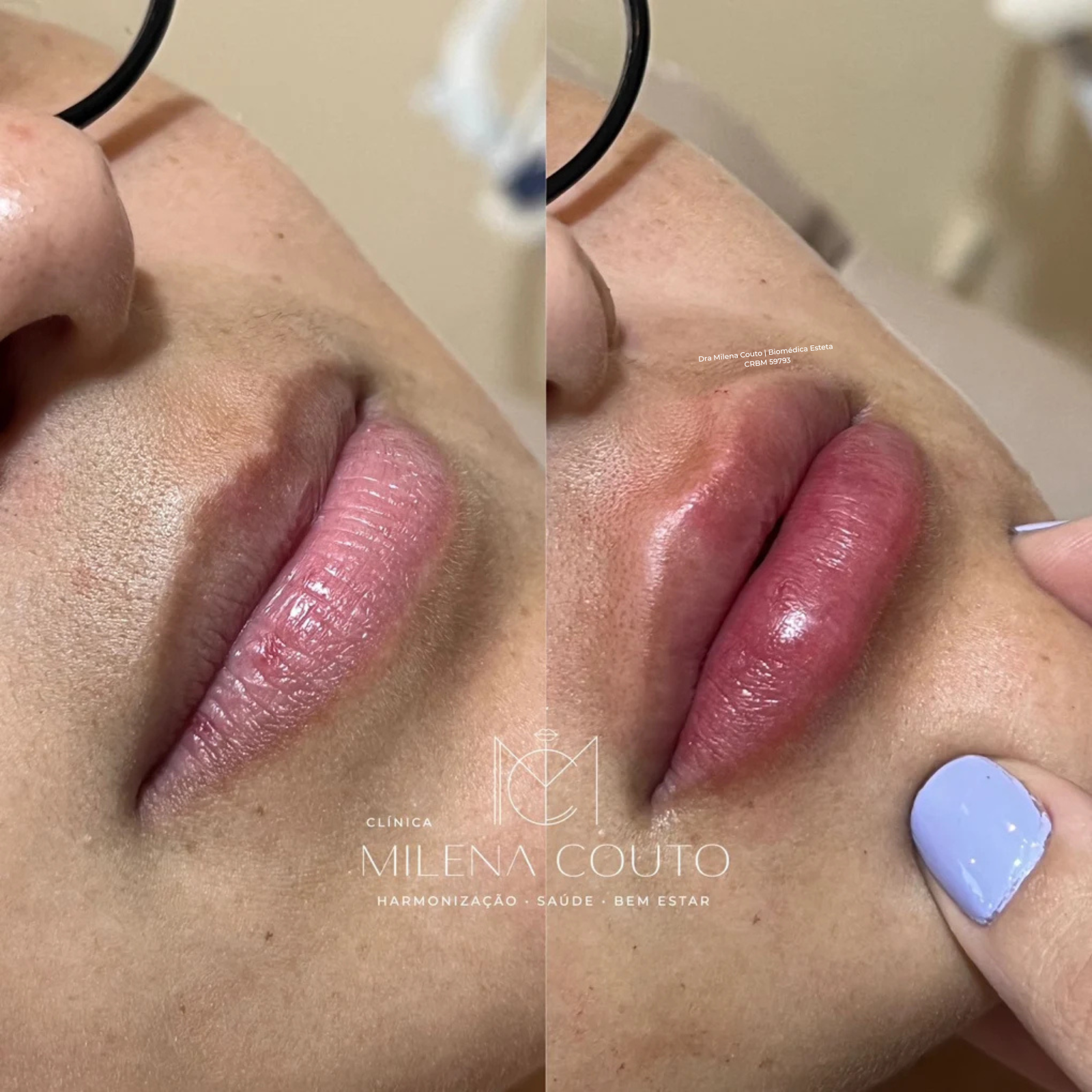 Preenchimento Labial