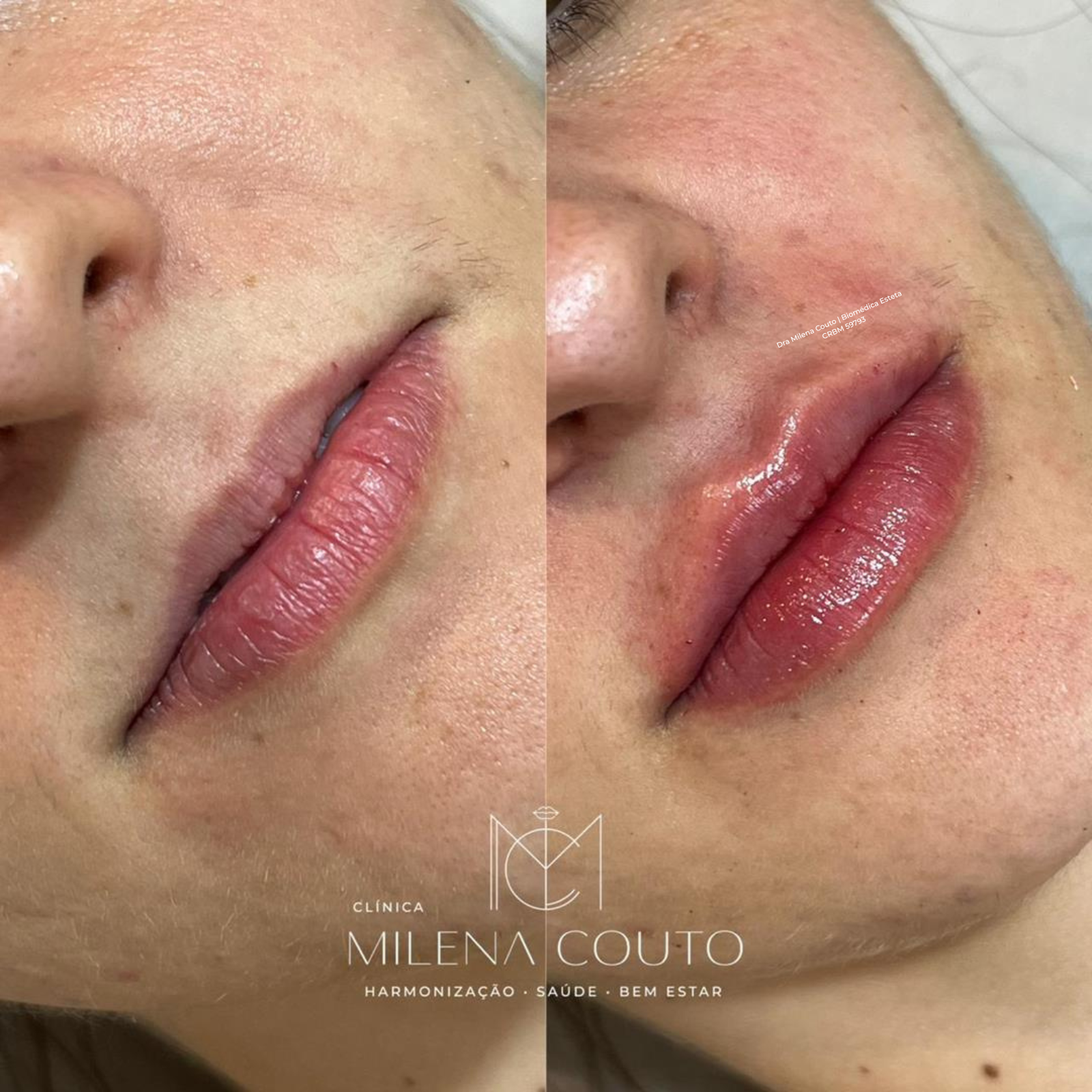 Preenchimento Labial