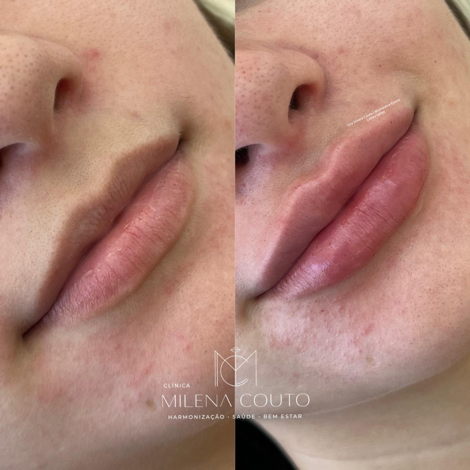Preenchimento Labial