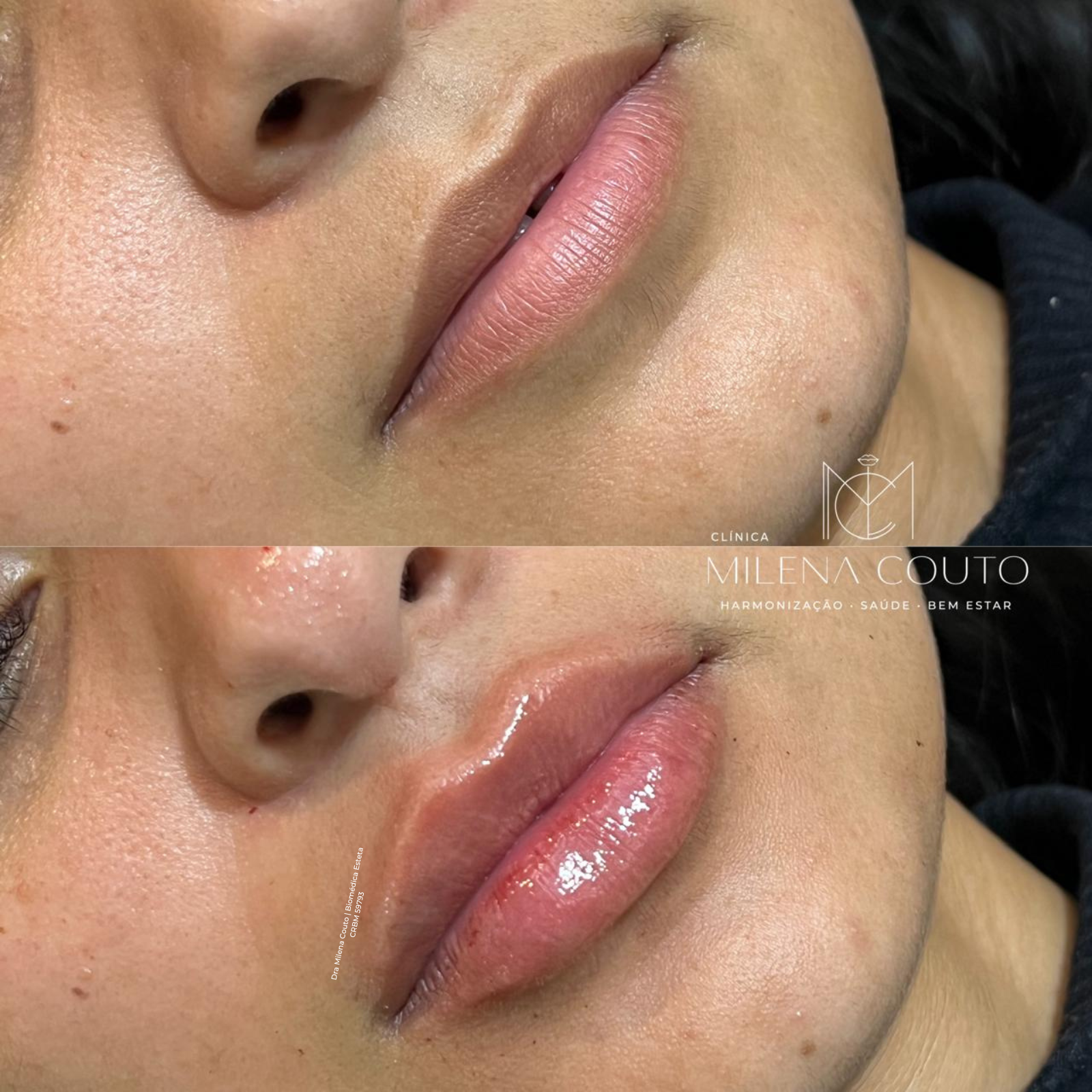 Preenchimento Labial