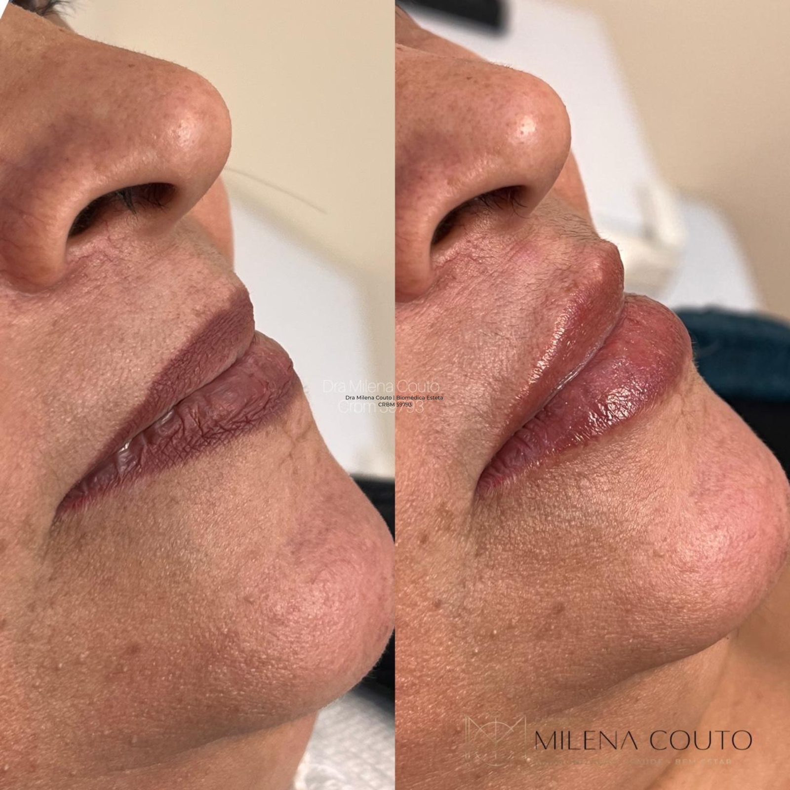 Preenchimento Labial