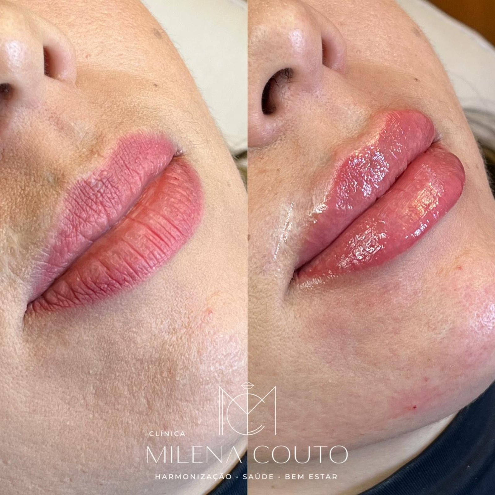 Preenchimento Labial
