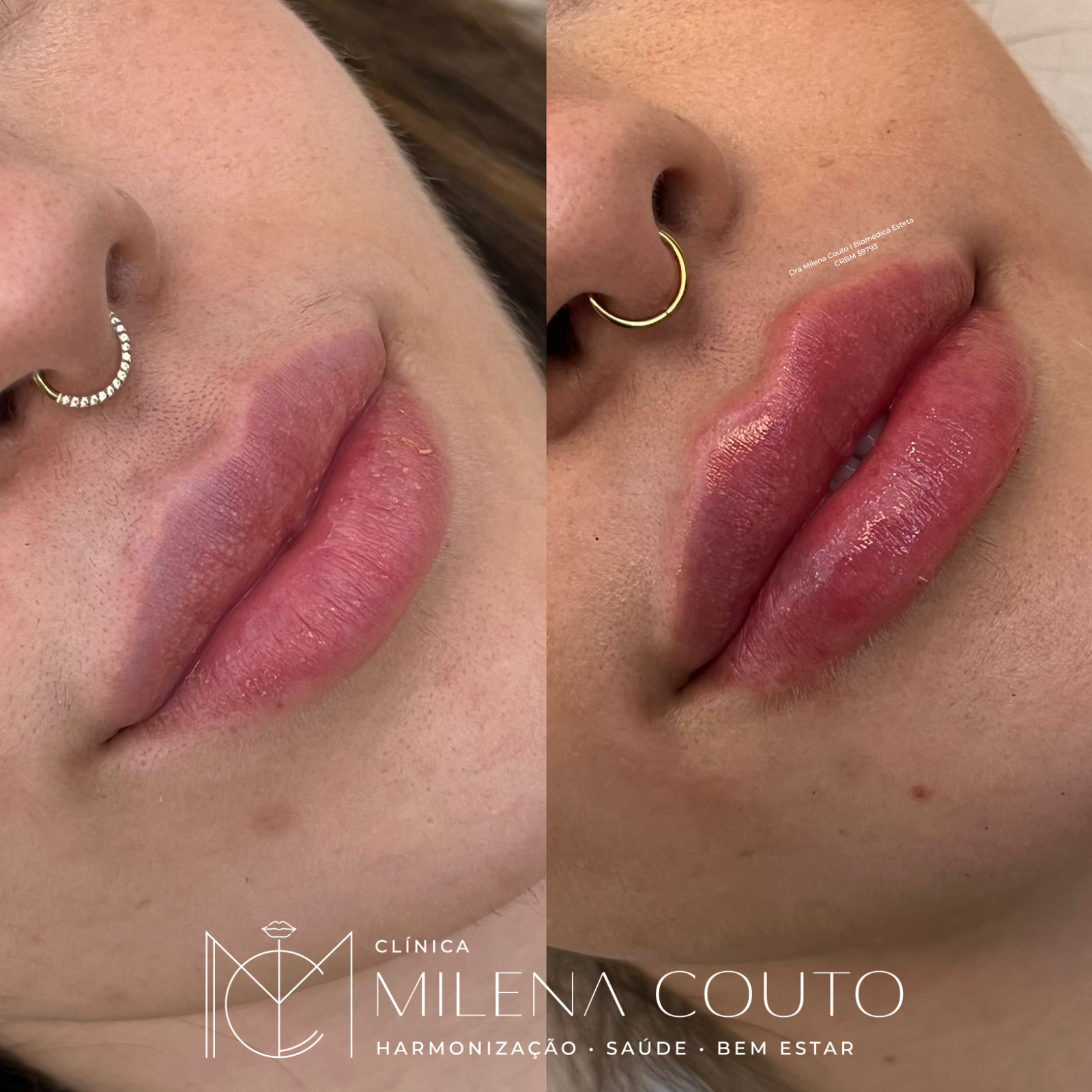 Preenchimento Labial