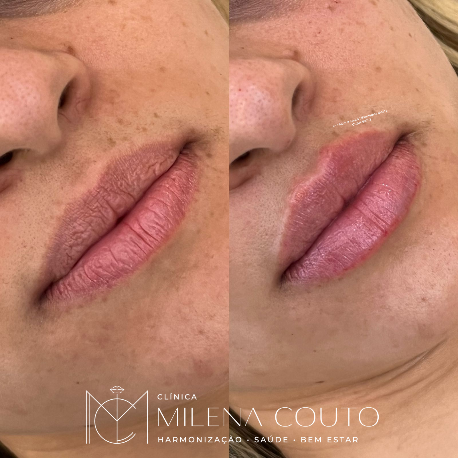 Preenchimento Labial